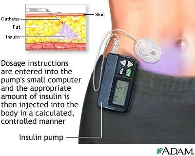 Microinfusore Insulinico