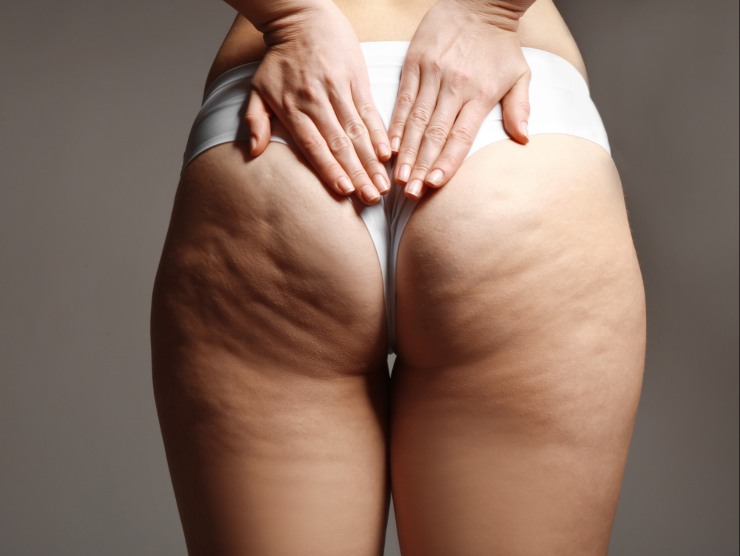 ricetta eliminare cellulite tiktok